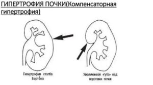 Компенсаторная гипертрофия единственной правой почки. Пиелоэктазия справа