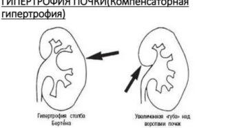 Компенсаторная гипертрофия единственной правой почки. Пиелоэктазия справа