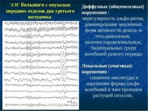 Что означает изменение корковой ритмики в результатах ЭЭГ