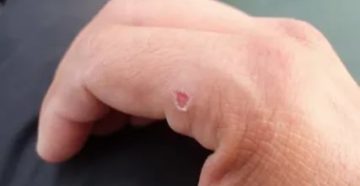 Ранки на пальцах не заживают Ранки на пальцах не заживают