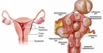 Миома, тонкий эндометрий и дюфастон