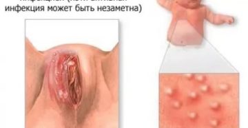 Зуд, жжение, боль, опухшие половые губы