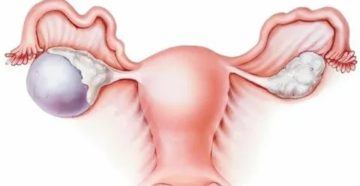 Киста яичника на фоне приема силуэт