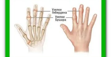Боль в среднем суставе безымянного пальца