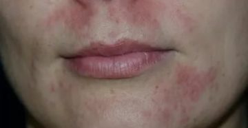 Пятна после периорального дерматита