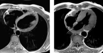 Можно ли делать МРТ при стентах на сосудах сердца