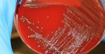 Посев из эякулята streptococcus mitis и streptococcus mitis