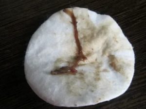 Коричневые выделения, лечение от молочницы