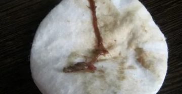 Коричневые выделения, лечение от молочницы