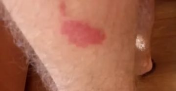 Ранки на ноге, сильное жжение Ранки на ноге, сильное жжение