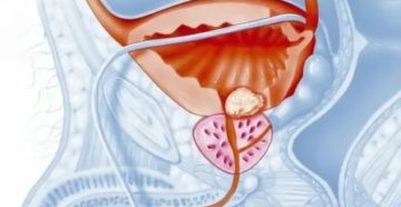 Кровь при мочеиспускании после первого секса