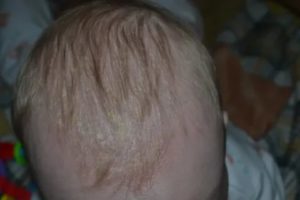 Красное пятно на голове младенца шелушится