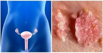 Кондиломы или нет?