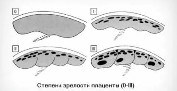 Преждевременное старение плаценты + кальциноз