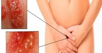 Продолжительный зуд половых губ и ануса