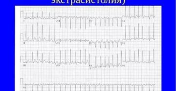 Экстрасистолы при гипотериозе