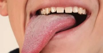 Сосочки сбоку языка Сосочки сбоку языка