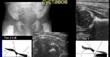 Дисплазия тазобедренного сустава тип 2б