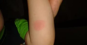 Пятно на руке у ребенка