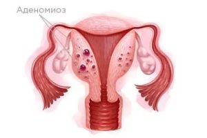 Фибромиома матки эндометриоз назначили инжеста окси не помешает?
