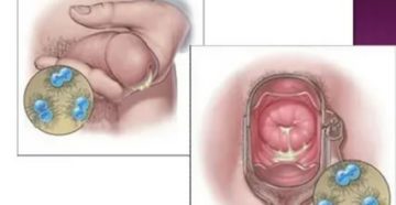 Порвался презерватив на фоне лечения от уреаплазмы парвум