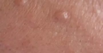 Прыщик на половом члене Прыщик на половом члене