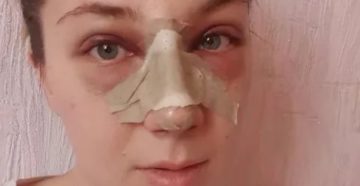 Не дышит нос после турбинопластики Не дышит нос после турбинопластики