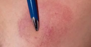 Пятно, похожее на синяк Пятно, похожее на синяк