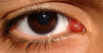 Покраснело и режет слезное мясцо одного из глаз Покраснело и режет слезное мясцо одного из глаз