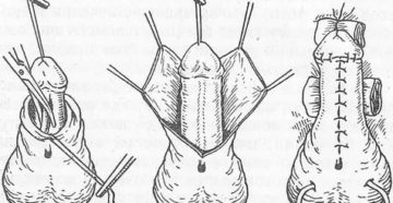 Не открывается головка при эрекции Не открывается головка при эрекции