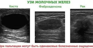 Фиброаденома и Атипичная киста Назначили порошки? Помогут они или нет