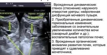 Как помочь ребенку-пиелоэктазия почек плода с обеих сторон 0,7мм.