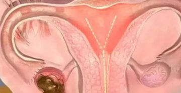 Месячные после удаления яичника