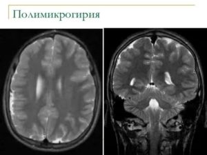 Каковы последствия полимикрогирии?