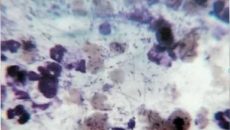 Коринобактерии и стафилококк в мазке из половых органов ребенка