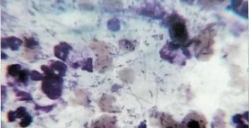 Коринобактерии и стафилококк в мазке из половых органов ребенка